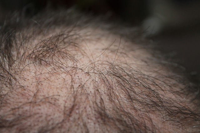 Revolutionäre Behandlung von Haarausfall: Orales Minoxidil bietet neue Hoffnung für Millionen